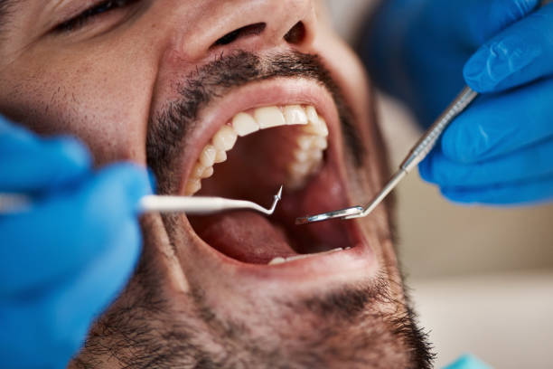 Best Emergency Wisdom Tooth Extraction in Brady, TX